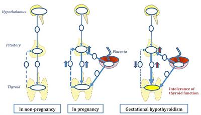 Understanding the Pathogenesis of Gestational Hypothyroidism